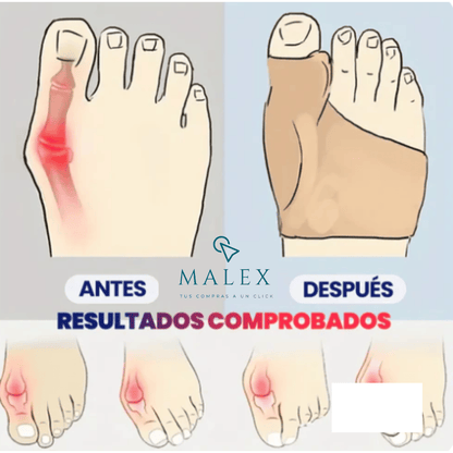 CORRECTOR DE JUANETES 2x1 | ELIMINA ALIVIA Y PREVIENE EL DOLOR