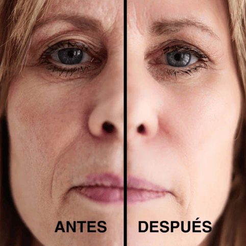 Parches Lifting Antiedad - Rejuvenece 15 años en 2 Minutos